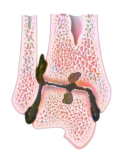 Hemophilic arthropathy in the ankle in frontal cut.