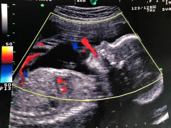 Fetal Ultrasound Fetus Its Head Profile Expels Amniotic Fluid Its — Stockfoto