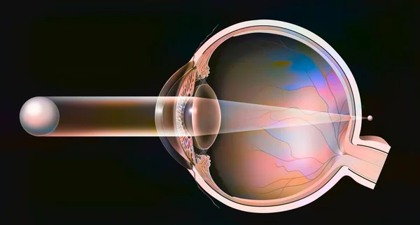 Presbyopic Eye Formation Image Retina —  Fotos de Stock