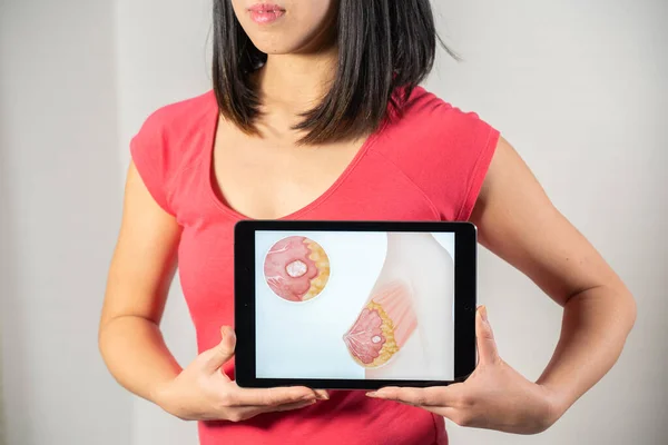 Woman Holding Screen Drawing Breast Cancer — 图库照片