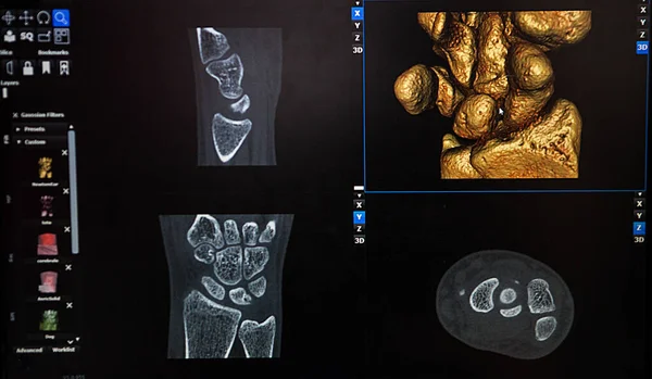 Reconstruction Image Patient Wrist Personalized Printing — 스톡 사진