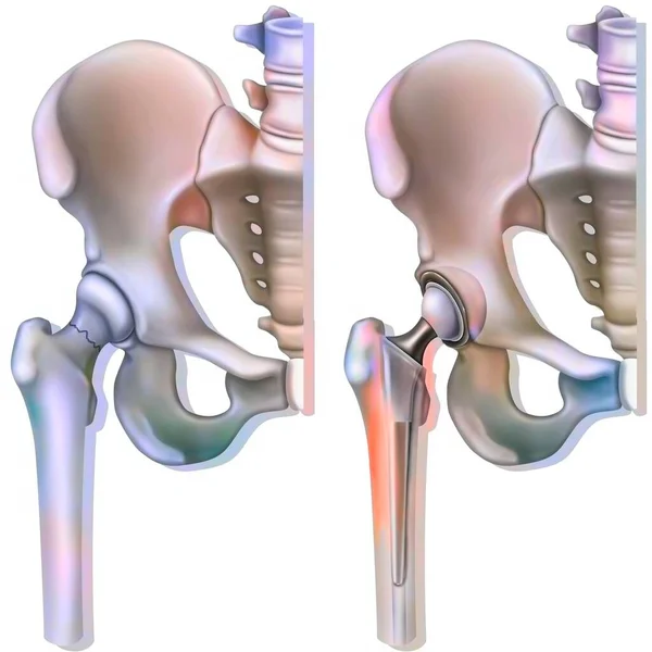 Femoral Neck Fracture Osteoporosis Hip Prosthesis — Stock Photo, Image