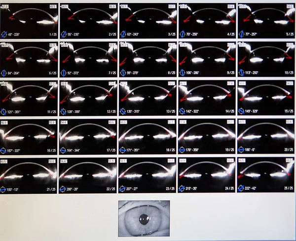 Corneal Sections Imaging Obtained Corneal Topographer — Photo