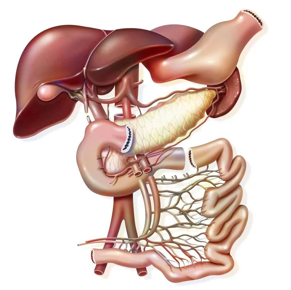 Illustration Pancreas Transplant Graft Removal — Stock Photo, Image