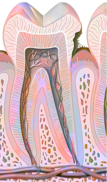 First Stage Tooth Decay Enamel Damage — Foto de Stock