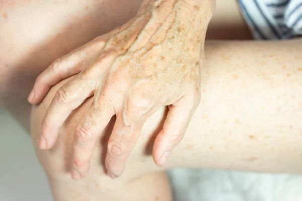 Hand Spots Old Age — Foto Stock