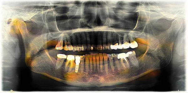 Dental Panoramic Year Old Person Implant Crowns — Stock fotografie