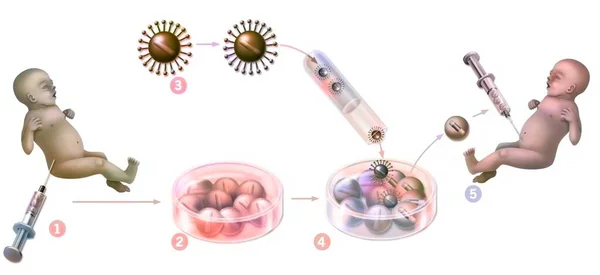 Генная Терапия Введение Ретровирусов Модификации Мутированных Клеток Спинного Мозга Новорожденного — стоковое фото