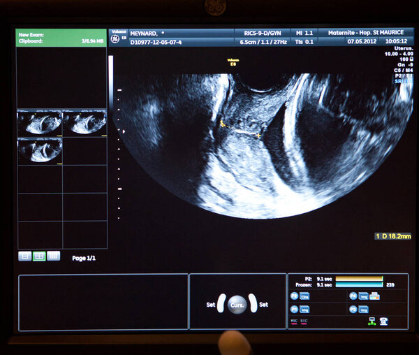 УЗИ шейки матки на шестом месяце беременности у женщины, беременной близнецами.