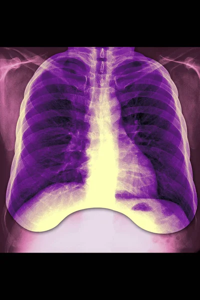 Lung Ray Result — Stock Photo, Image