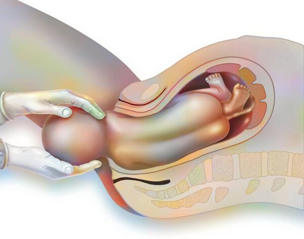 Роды, шаг 3: освобождение верхнего плеча акушеркой.
