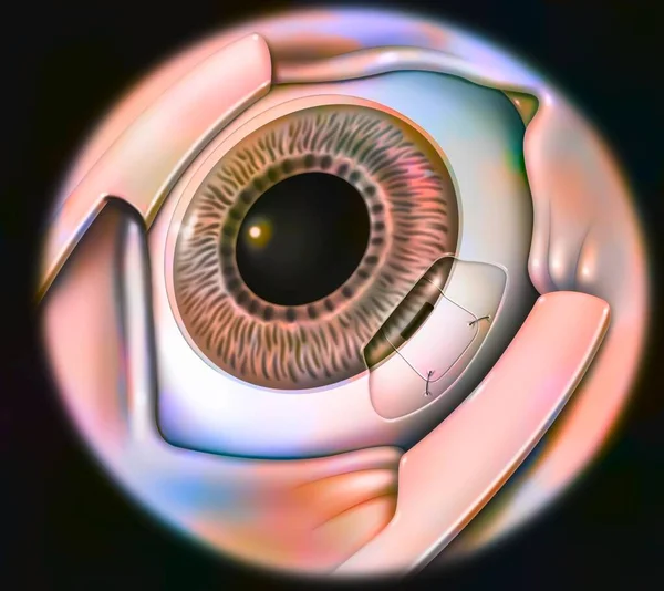 Eye Glaucoma Sclerectomy Sclera Suture — Stockfoto