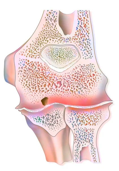 Hemophilic Arthropathy Elbow Hemarthrosis Sagittal Section — Foto Stock