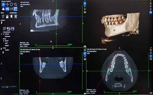 Reconstruction Image Patient Jaw Personalized Printing — Stock fotografie