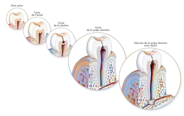 Tooth Formation Development Dental Caries — Zdjęcie stockowe