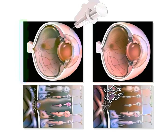 Eye Treatment Macular Degeneration Rna Interference — Zdjęcie stockowe