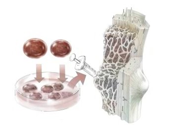 Transplant of hematopoietic stem cells administered to colonize the bone marrow.