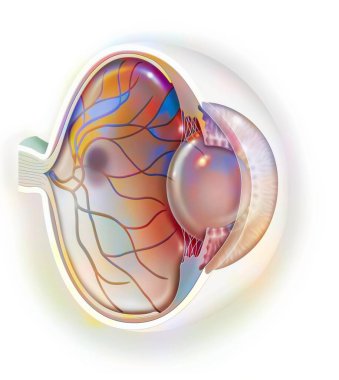 Age-related macular degeneration affecting the macula, the central area of the retina.
