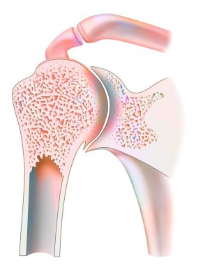 Healthy ankle with hemophilic arthropathy in frontal cut.