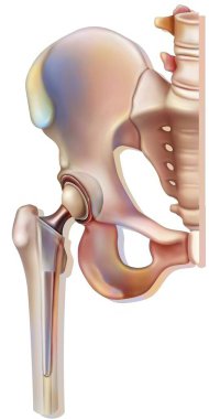 Bone system: hip prosthesis. clipart