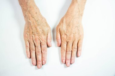 One hand with spots of old age and the other one laser treated.