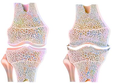 Healthy knee with osteoarthritis with degradation and abrasion of cartilages.