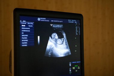 Fetal ultrasound of the 1st trimester of the fetus, in a radiology center.