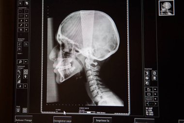 X-ray of the skull of a teenage girl in a radiology center.
