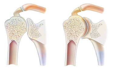 Healthy ankle with hemophilic arthropathy in frontal cut.