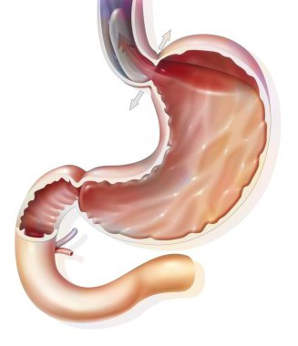 Stomach: gastroesophageal reflux disease in the gastroesophageal sphincter.