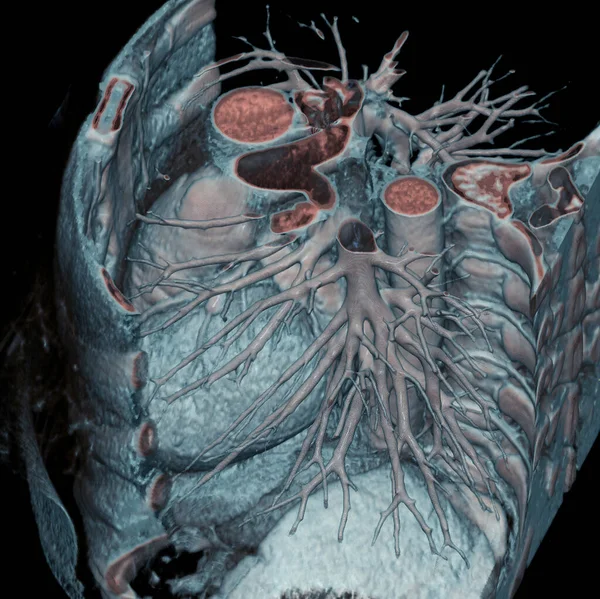 Thorax Heart Aorta Pulmonary Artery Visible Scan — Stock Photo, Image