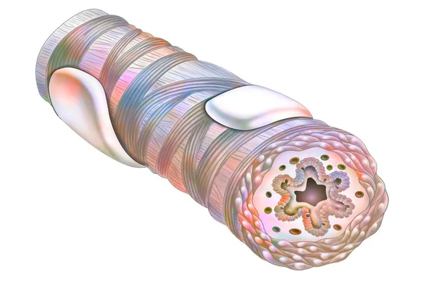 Bronchus Asthmatic Wall Bronchus Thicker — ストック写真