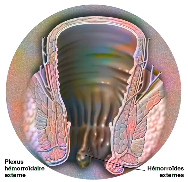 External Hemorrhoidal Plexus Location External Hemorrhoids —  Fotos de Stock