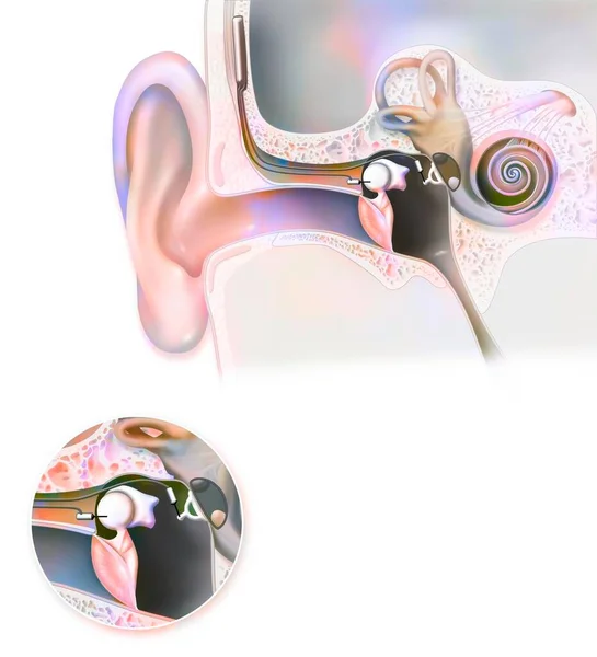 Ear: hearing aid (Esteem) implantable in the inner ear.