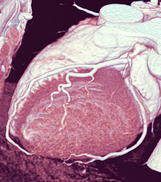 Scan Normal Coronary Arteries — Stock Photo, Image