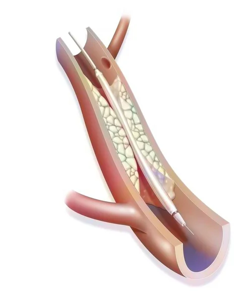 Balloon Catheter Angioplasty Step Introduction Catheter Equipped Balloon Blocked Artery — ストック写真