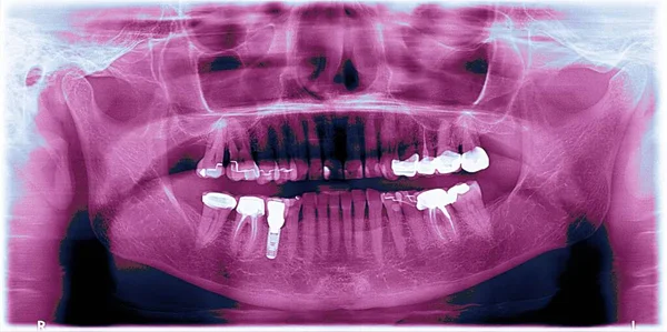 Dental Panoramic Year Old Person Implant Crowns — Photo