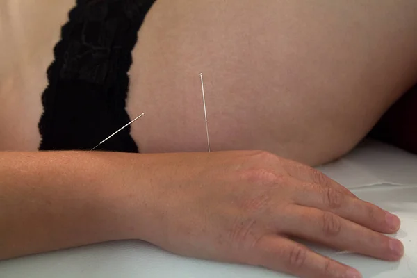 Therapist Specializing Traditional Chinese Medicine Practicing Acupuncture — Foto de Stock