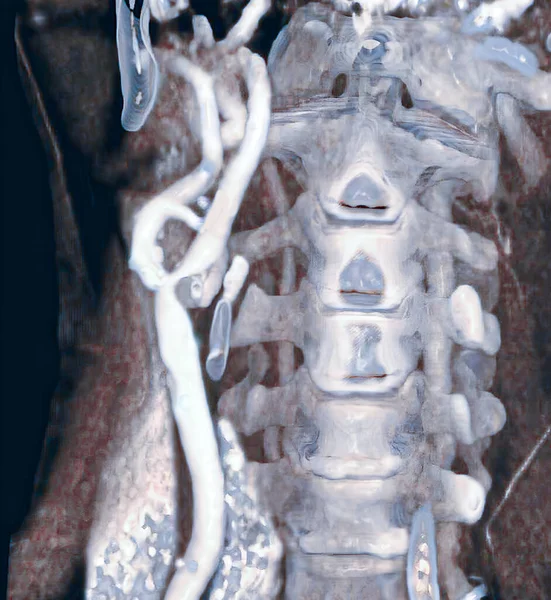 Αξονική Τομογραφία Στενωμένης Καρωτίδας Αρτηρίας Υπεύθυνη Για Εγκεφαλικό Επεισόδιο — Φωτογραφία Αρχείου