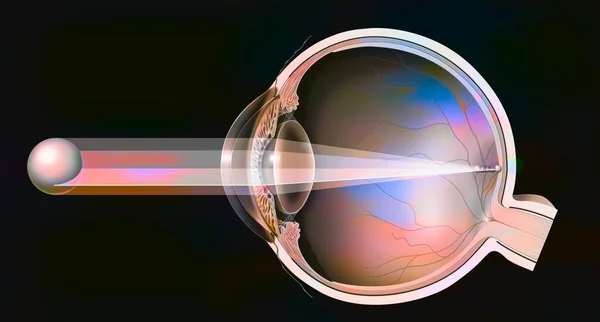 Astigmatic Eye Ovoid Non Spherical Cornea Formation Image — Foto Stock