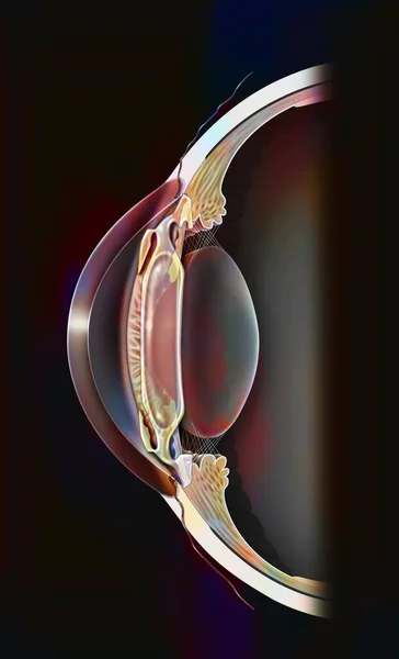 Eye Intraocular Implant Anterior Chamber Cornea Iris — Stockfoto