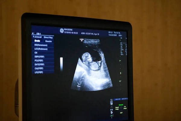 Εμβρυϊκός Υπέρηχος 1Ου Τριμήνου Του Εμβρύου Ακτινολογικό Κέντρο — Φωτογραφία Αρχείου