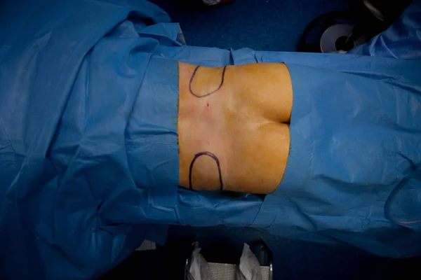 Косметическая Хирургия Операция Липосакции Талии — стоковое фото