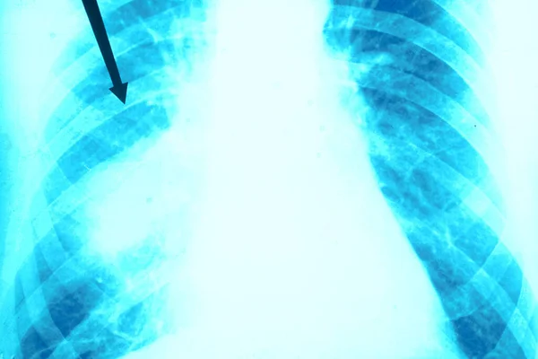 Lung Cancer Ray — Stok fotoğraf