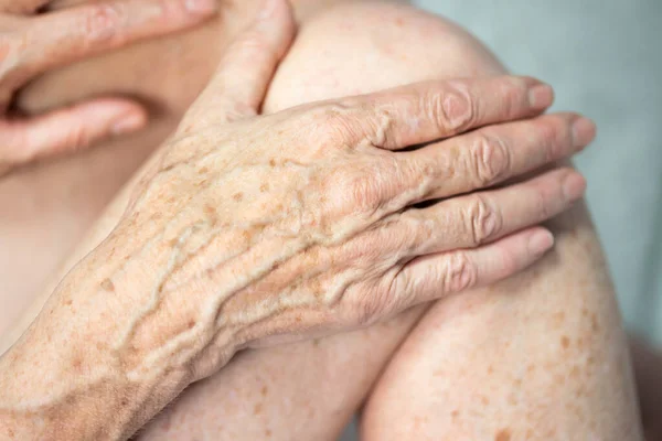 Hand Spots Old Age — Foto de Stock