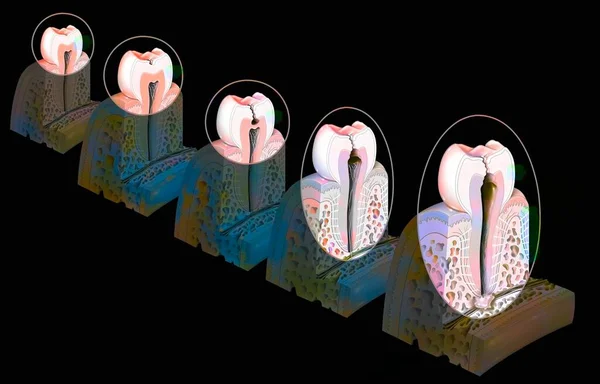 Tooth Formation Development Dental Caries — Stok fotoğraf