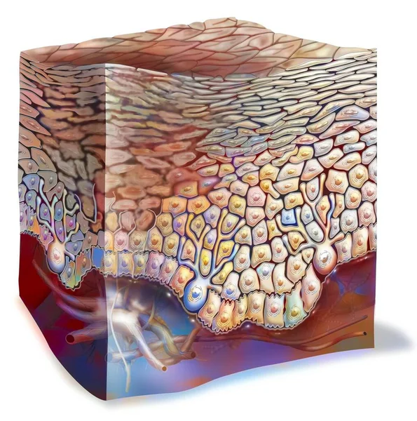 First Degree Sunburn Keratinocytes Destroyed — Foto de Stock