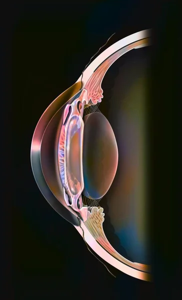 Eye Intraocular Implant Anterior Chamber Cornea Iris — 图库照片