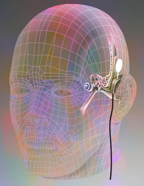 Simulation New Generation Cochlear Implant — Zdjęcie stockowe