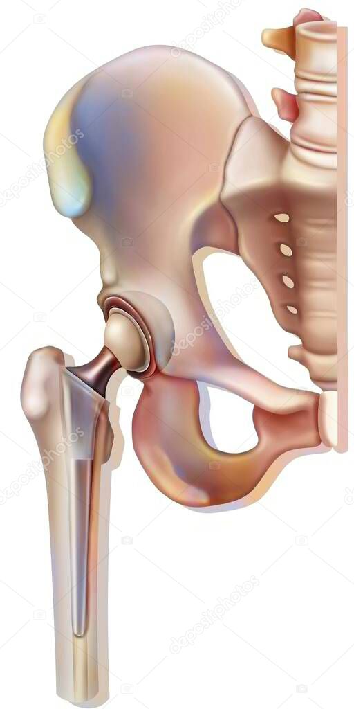 Bone system: hip prosthesis.